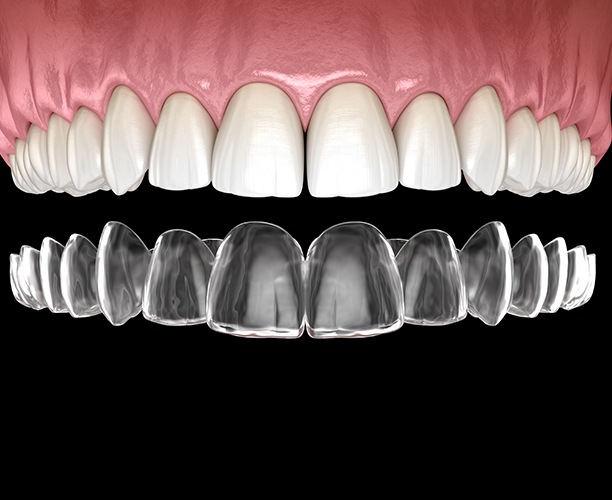 Animated smile fitted with Invisalign tray