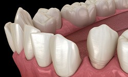 Illustration of gapped teeth