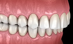 Illustration of an overbite