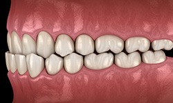 Illustration of an underbite