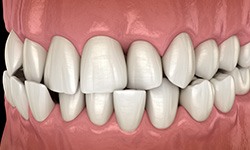 Illustration of a crossbite