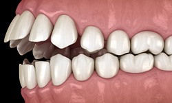 Illustration of an open bite