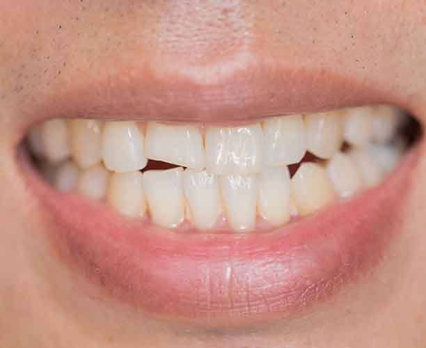 Up-close view of a chipped tooth