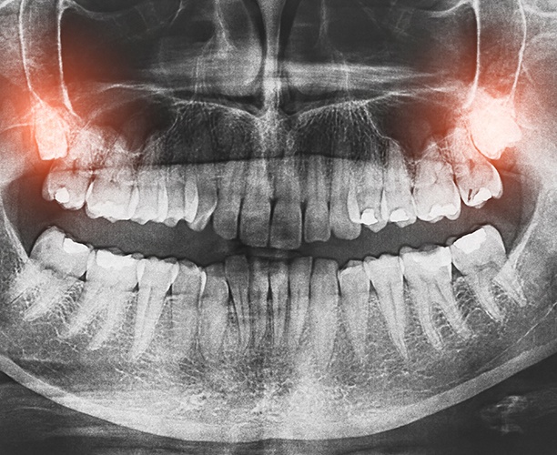 X-ray of smile with impacted wisdom teeth
