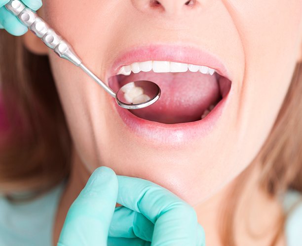 Dentist examining patient's smile after tooth colored filling treatment