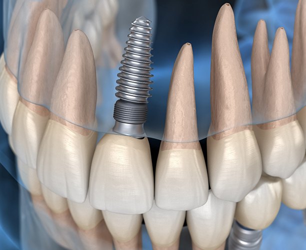 model of an X-ray of a patient with dental implants in Las Cruces 