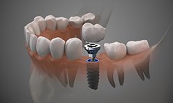 model of a single dental implant in the lower jaw 