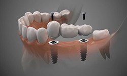 model of two dental implants supporting a dental bridge 