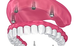 model of four dental implants supporting a full denture 