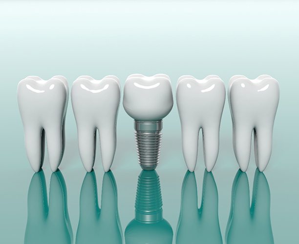 model of a dental implant in the middle of several real teeth 