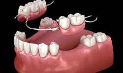 partial denture replacing several missing teeth