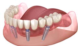model of a single dental implant in the lower jaw 