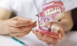 Dentist’s hands holding model implant bridge