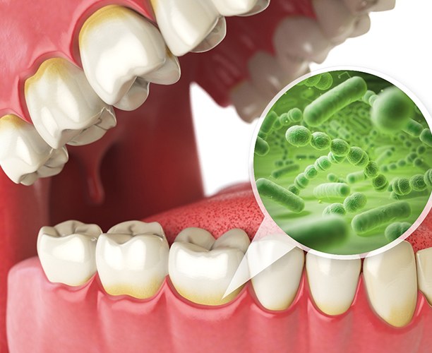 Illustration of bacteria on model of teeth