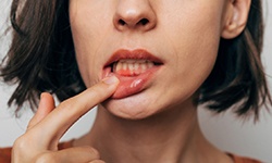 Woman with gum irritation