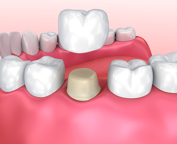 Animated smile during dental crown restorative dentistry placement