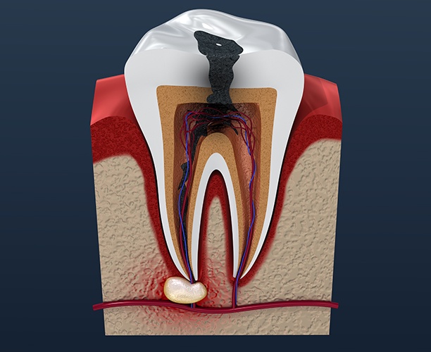 Animated decayed tooth in need of root canal therapy
