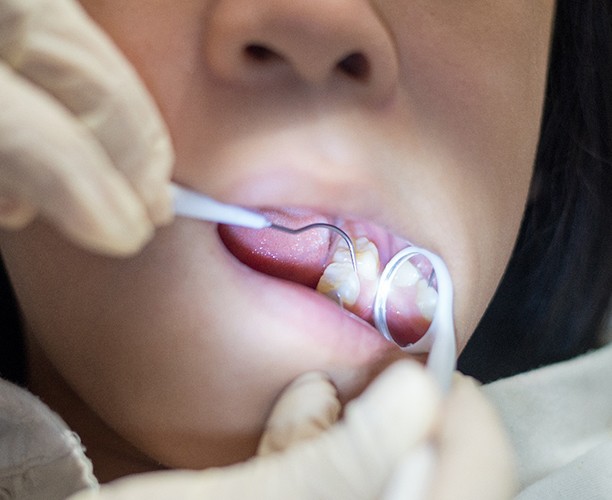 A child getting a dental sealant placed at the dentist