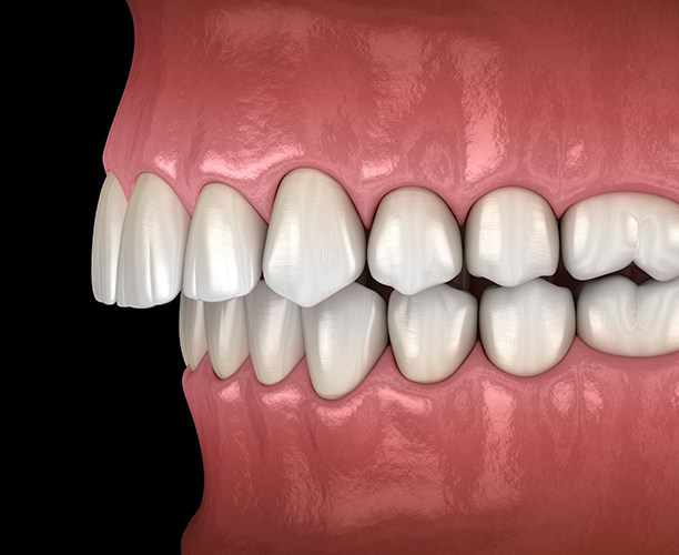 Animated smile in need of occlusal adjustment