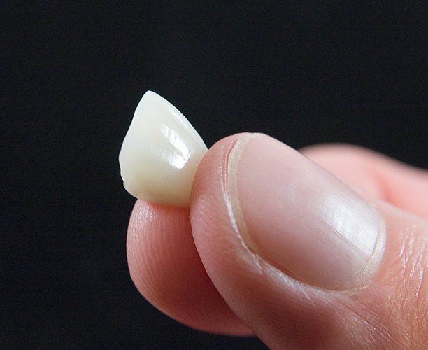 Hand holding a porcelain veneer prior to placement