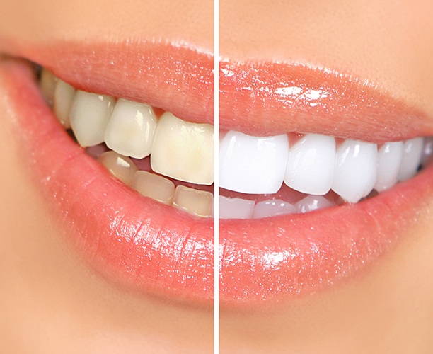 Closeup of smile that’s halved to show before/after teeth whitening results