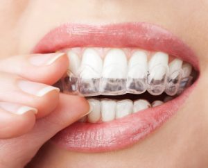 Fix your smile discreetly with Invisalign from your dentist in Las Cruces. Drs. Ramon and Natalie Ortiz are experts in this remarkable orthodontic system.