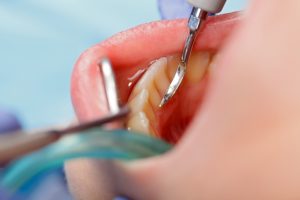Your dentist in Las Cruces advises semi-annual check-ups