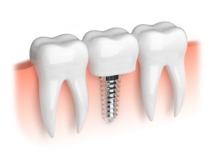 Dental implant