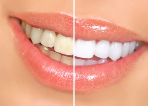 woman smiling before and after whitening