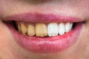 Before and after teeth whitening at dentist in Las Cruces.