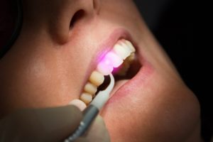 Woman’s teeth during procedure at dentist in Las Cruces.