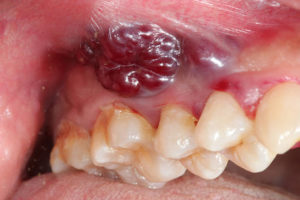 Cancerous growth in mouth