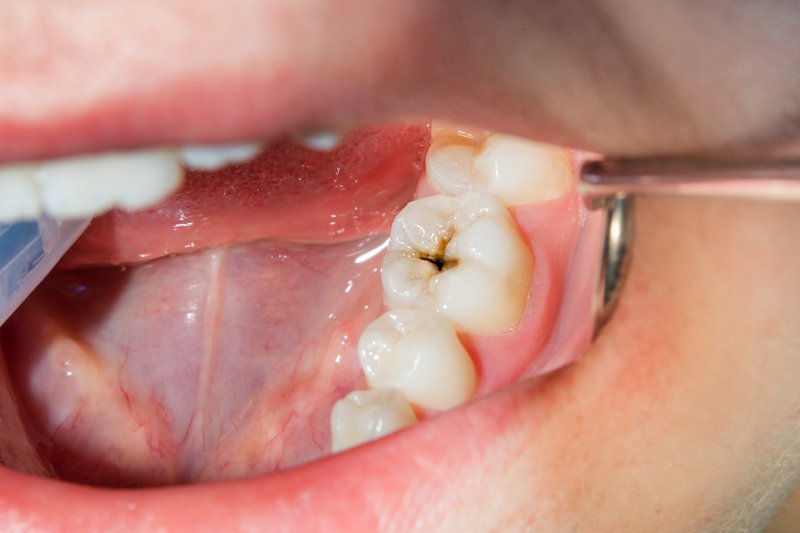 A closeup of a tooth with a cavity, one of several common oral health issues