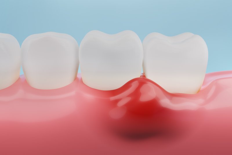 Illustration of gingivitis