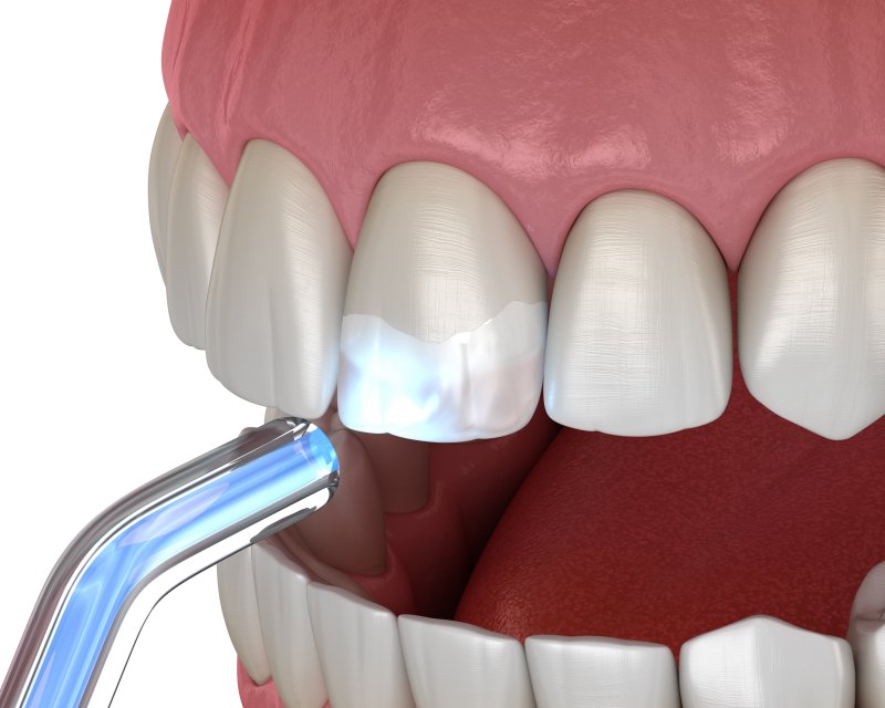 digital image of direct tooth bonding