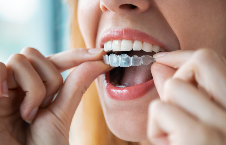Woman putting Invisalign on top teeth