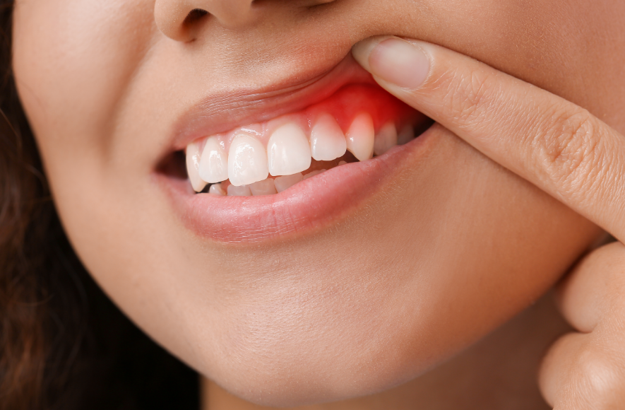 Woman showing inflamed gums